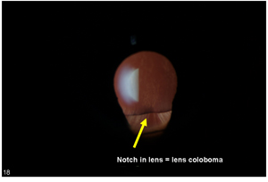 Lens Coloboma