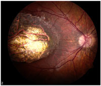 Macular Coloboma