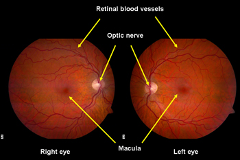 Normal fundus - source: NEI