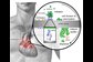 stages of biofilm formation on prosthetic hear valves