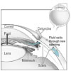 Conventional surgery to treat glaucoma makes a new opening in the meshwork.  This new opening helps fluid to leave the eye and lowers intraocular pressure.

