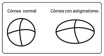 Cornea both Normal and Astigmatismo