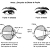 Antes y después de dilatar la pupila.