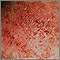 Dermatitis, close-up of allergic contact