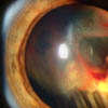 Slit lamp photograph showing retinal detachment.