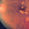 Fundus photo showing focal laser surgery for diabetic retinopathy.