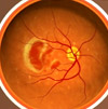 Advanced age-related macular degeneration.