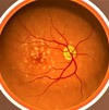 Late intermediate age-related macular degeneration.