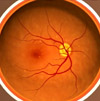 Early age-related macular degeneration.