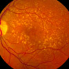  A fundus photo showing intermediate age-related macular degeneration.