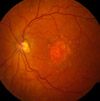 A fundus photo showing geographic atrophy associated with dry age-related macular degeneration.