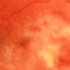 Fundus, photograph-CMV retinitis