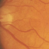 In background retinopathy