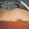 An artist's conception of the interior of an infant's eye shows the formation of an ROP ridge.