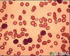 Photograph of a microscopic view of bone marrow with chronic lymphocytic leukemia