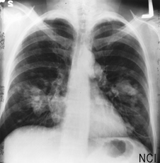 X-ray of a chest showing a growth on the left side of the lung, which could be lung cancer