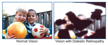 The first photo simulates normal vision.  The second photo simulates diabetic retinopathy.