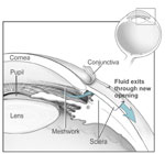 glaucoma treatment