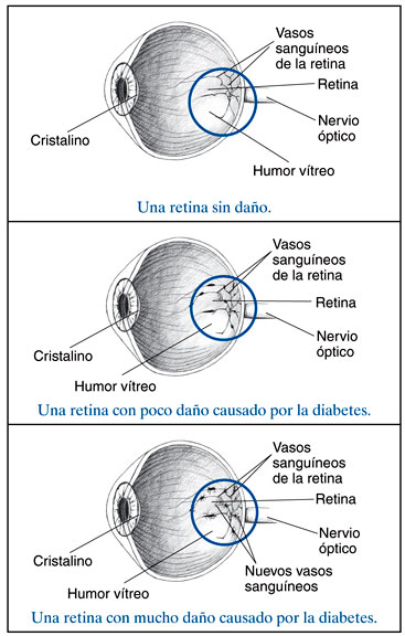 Tres ilustraciónes de la sección trasversal del ojo enseñando la retina. La primera ilustración enseña poco daño diabético en la retina, la segunda enseña leve daño diabético en la retina y la tercera muestra mucho daño diabético en la retina. Se etiquetan la retina, los vasos sanguíneos de la retina, el nervio óptico, el humor vítreo y el cristalino.