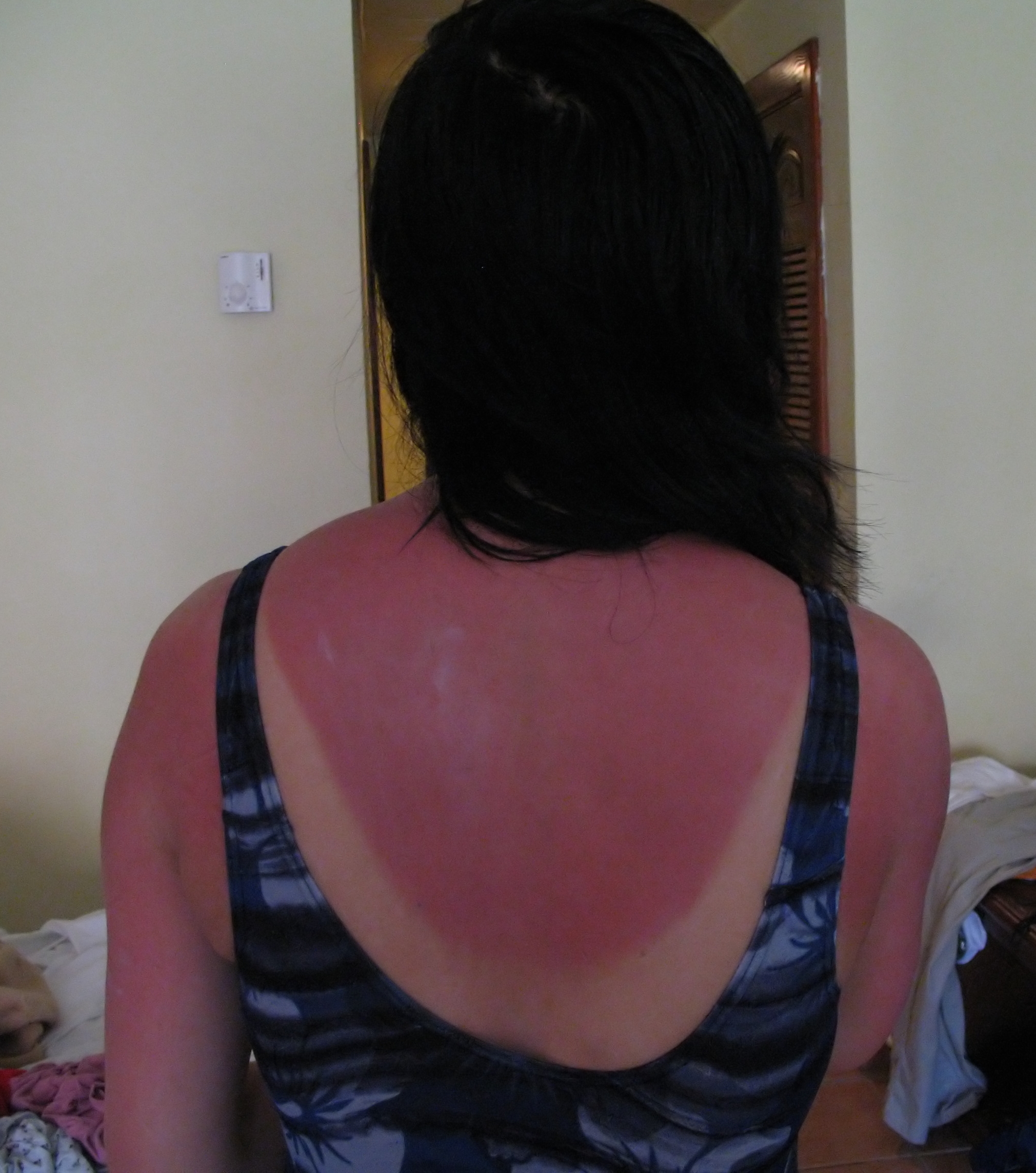 Example of a severe sunburn