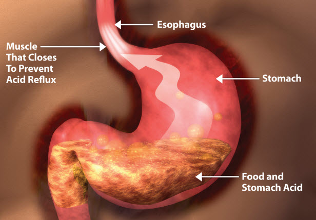 GERD stomach image.