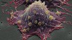 Bowel cancer cell