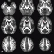 Series of MRI Scans of the Brain