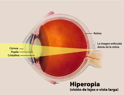 Hyperopia