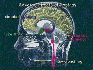 Brain Showing Adverse Effects on Ecstasy