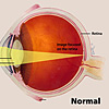 A color illustration of the eye highlighting the cornea, pupil and lens, and the way an image focuses on the retina.