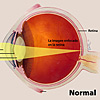 Ilustración a color del  ojo destacando la córnea, la pupila y el cristalino, y como la imagen se enfoca  en la retina.