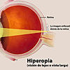 Ilustración a color de la hiperopía destacando la córnea, la pupila y el cristalino, y como la imagen se enfoca detrás de la retina. 