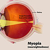 A color illustration of myopia highlighting the cornea, pupil and lens, and the way an image focuses in front of the retina.