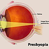 A color illustration of myopia highlighting the cornea, pupil and lens, and the way an image focuses behind the retina.