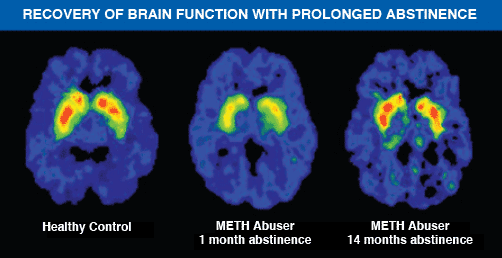 Brain scans showing that research is beginning to show that recovery of brain function may be possible with prolonged abstinence