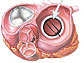 Illustration shows circular mechanical valve inside heart.