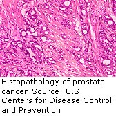 Breast Cancer Drug Might Help Men on Prostate Cancer Therapy