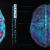 This picture is showing us an inside view of the brain from the top down. It compares healthy brain activity (left side, with all the red areas) with diminished brain activity in a drug user (right side).