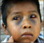 Child with broken blood vessels in eyes and bruising on face due to pertussis coughing.