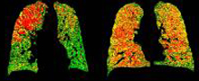 Images of lungs with green, yellow and red areas.