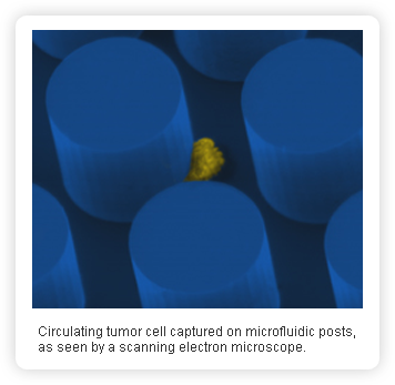 Circulating tumor cell captured on microfluidic posts, as seen by a scanning electron microscope.