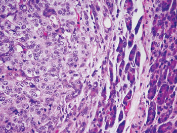 Image shows a micrograph of metastatic melanoma cells, left, that have invaded pancreatic tissue, right.