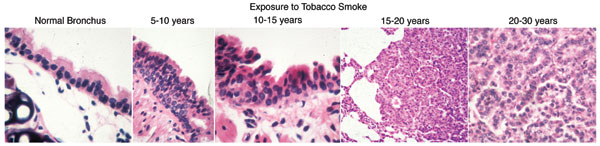 Image shows that exposure to tobacco smoke over a lifetime causes normal cells from a lung bronchus to progress to hyperplasia (5-10 years later), dysplasia (10-15 years later), carcinoma in situ (15-20 years later), and, eventually, malignant adenocarcinoma (20-30 years later).
