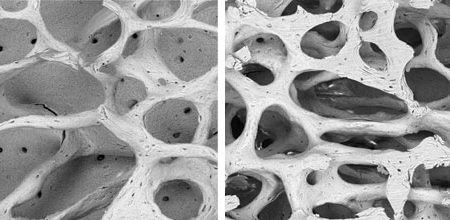 Scanning electron micrographs (SEM) of trabecular bone architecture in normal mice (left panel) and mice with mutations in the thyroid hormone receptor TRα. Image adapted from Bassett et al., Scanning, (Author manuscript; available in PMC 2009 July 6).