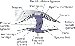 images of a joint with osteoarthritis