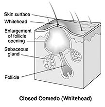 Illustration of lesion, Closed Comedo (Whitehead)